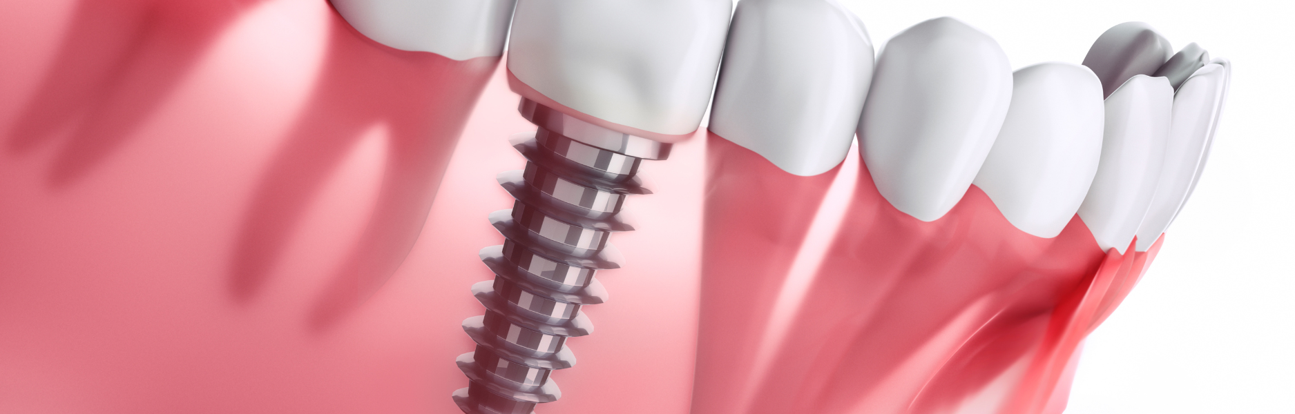 Navigating Dental Implant Costs and Warranties: A Comprehensive Guide for Patients